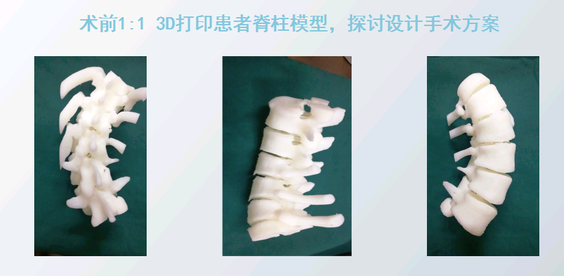 上海數(shù)造攜手安徽省二院骨三科專(zhuān)家章玉冰主任 開(kāi)展3D打印醫(yī)療骨科應(yīng)用在線講堂